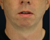 Feel Beautiful - Chin Implant 204 - Before Photo